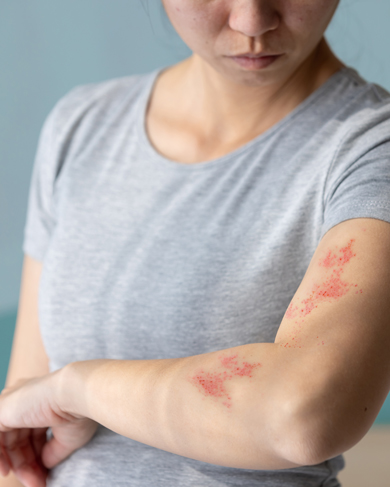 woman in a gray t-shirt showing skin condition on arm with red spots