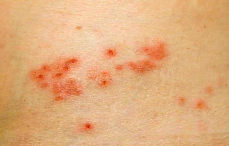 Symptoms and Treatments of Shingles